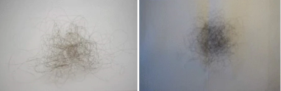 Normal daily hair loss