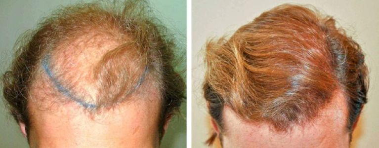 Patient's hairline and mid-scalp before and after 3000 grafts FUT hair transplant
