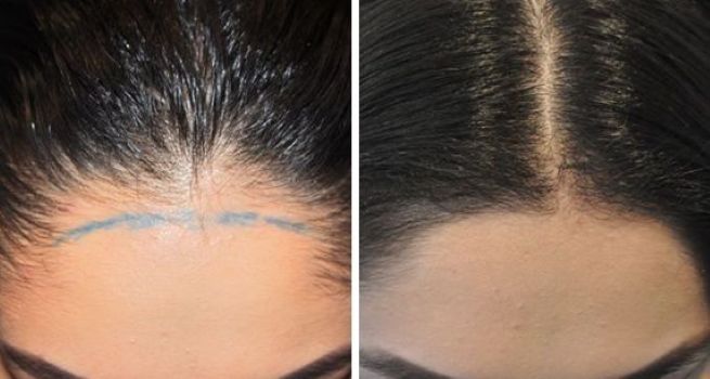 Female Wimpole patient before and 6 months after 800 graft hair transplant