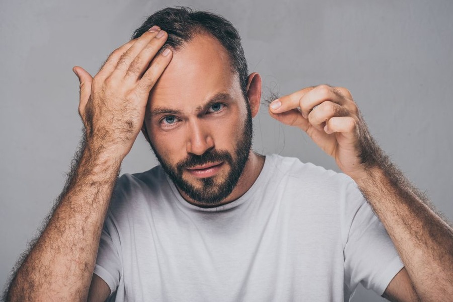 Androgenetic Alopecia