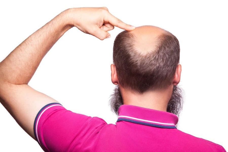 How Many Hair Transplants Can A Person Have