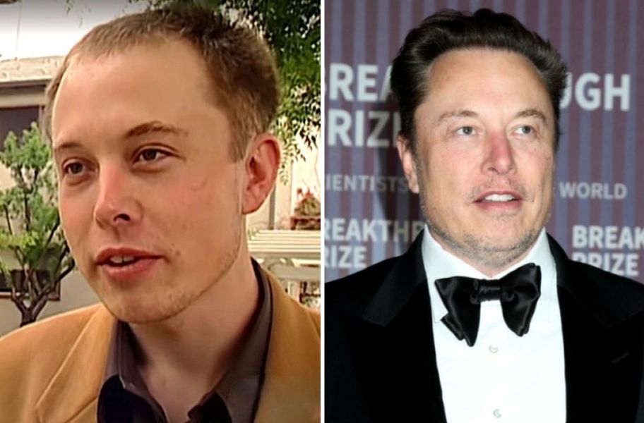 Elon Musk’s Hair Transplant: Full Timeline, Cost and Results