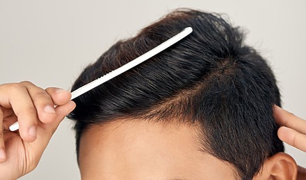 Hair Transplant For Density