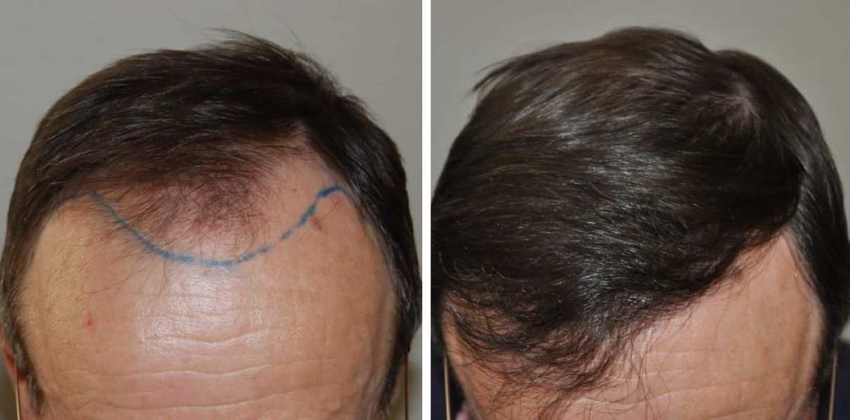 1500-Grafts Hair Transplant: Coverage, Results, Risks & Costs