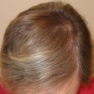 After the hair transplant