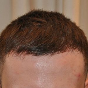 After hair transplant