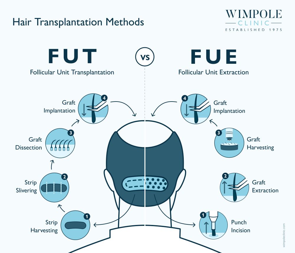 FUE vs FUT for widow’s peaks infographic