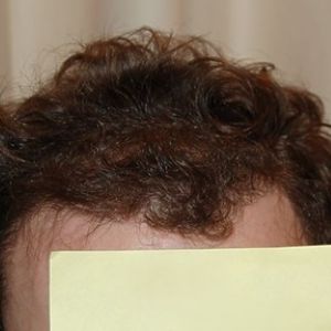 After hair transplant