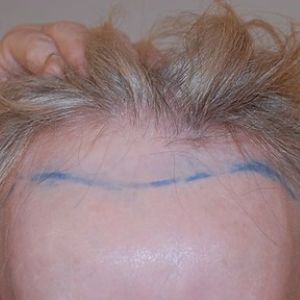before the hair transplant