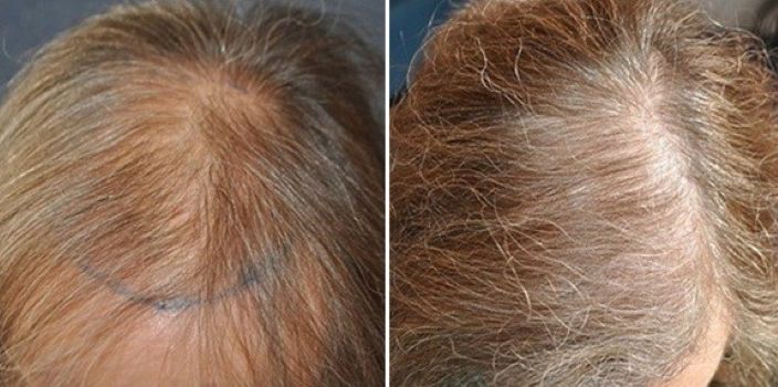 Before and 6 months after a hair transplant at the Wimpole Clinic