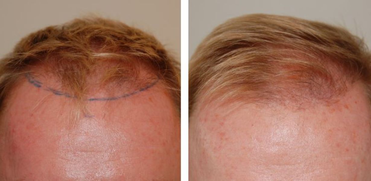 Hair Transplant After 4 Months: Photos, Results, Side Effects