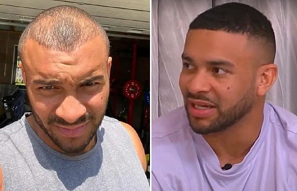 Jonathan Joseph hair transplant