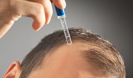 Minoxidil For A Receding Hairline