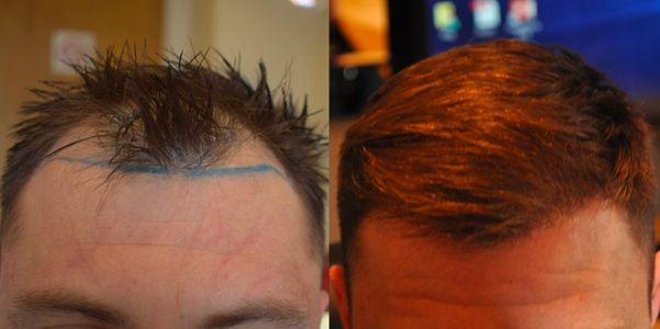 1900 graft FUE hair transplant patient after 6 months