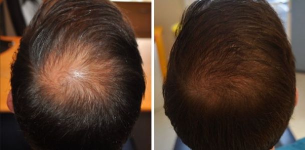 Wimpole patient's crown before and 6 months after 2000 grafts FUE hair transplant