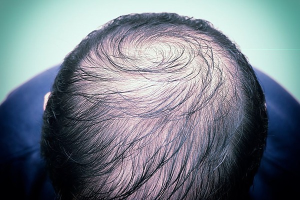 my hair is so thin i can see my scalp