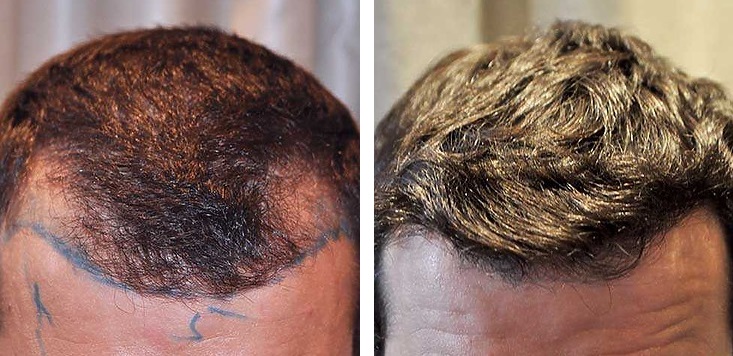 Patient before and after a hairline hair transplant