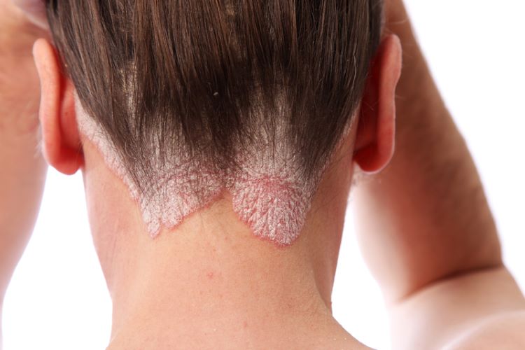Woman with scalp psoriasis