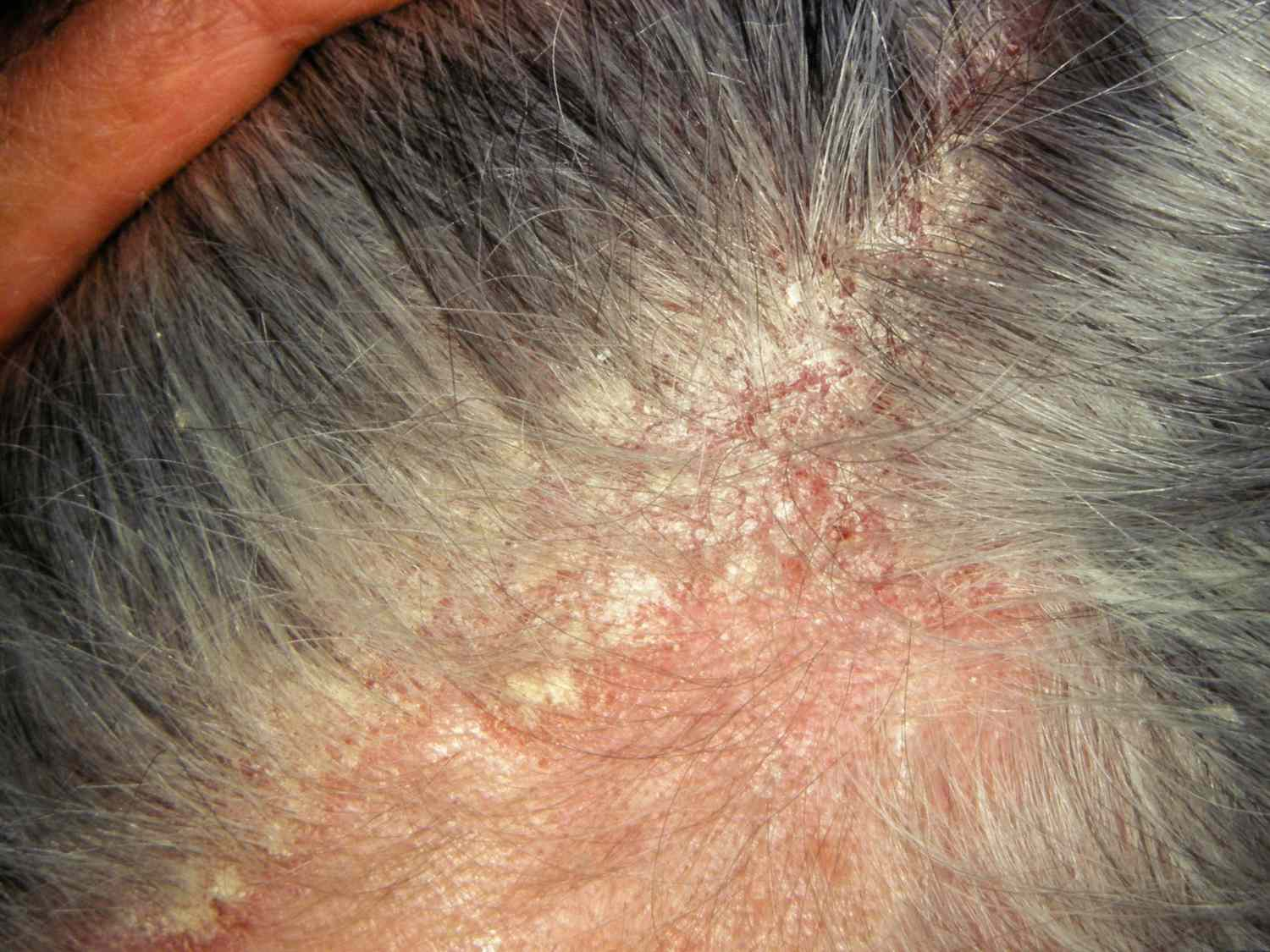 Seborrheic dermatitis on the scalp