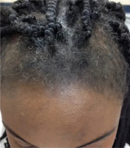why is my hair thinning at 23 female: traction alopecia