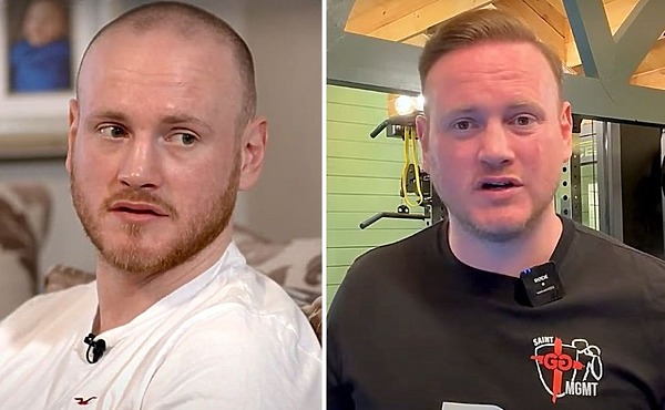 George Groves before and after hair transplant