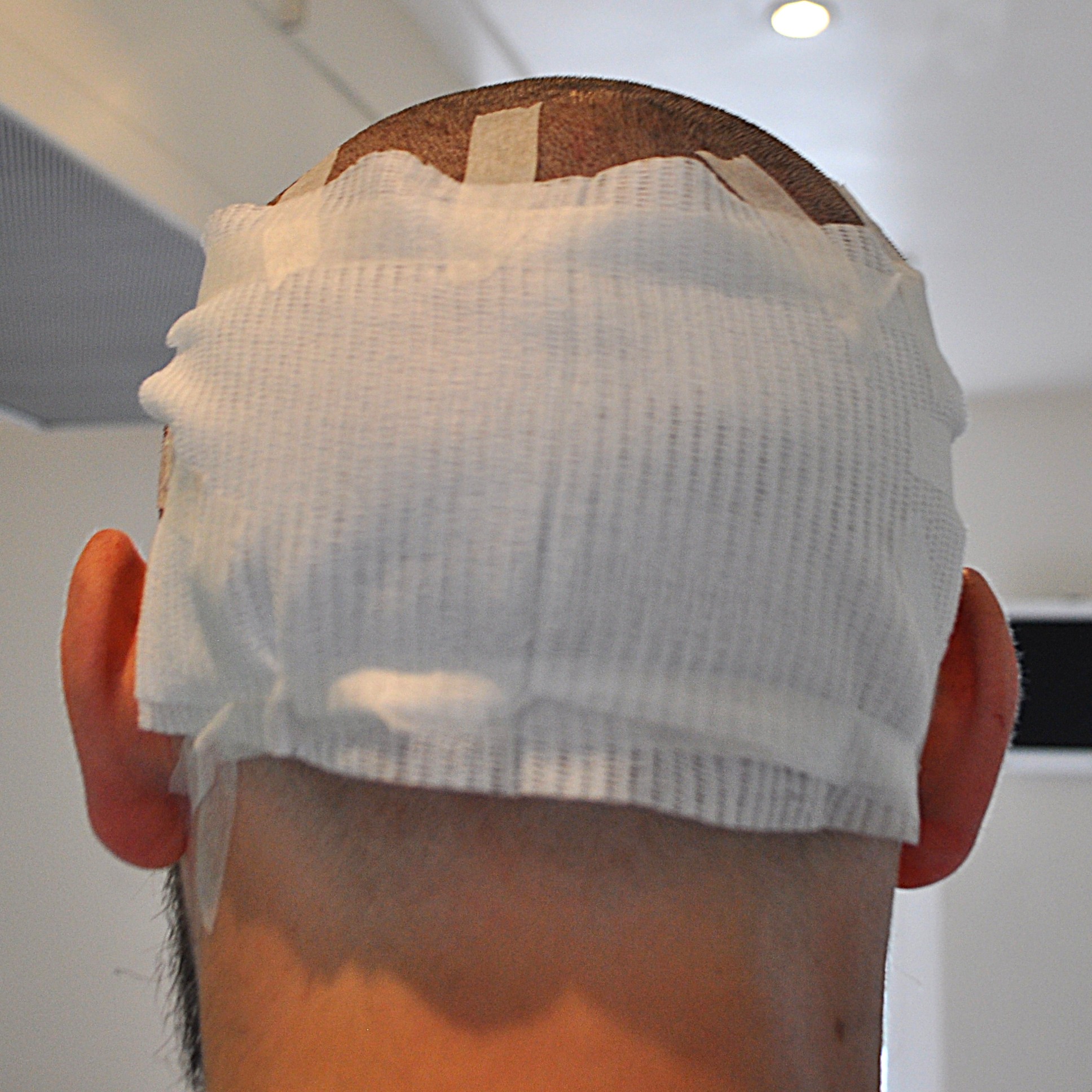 Post hair transplant bandage