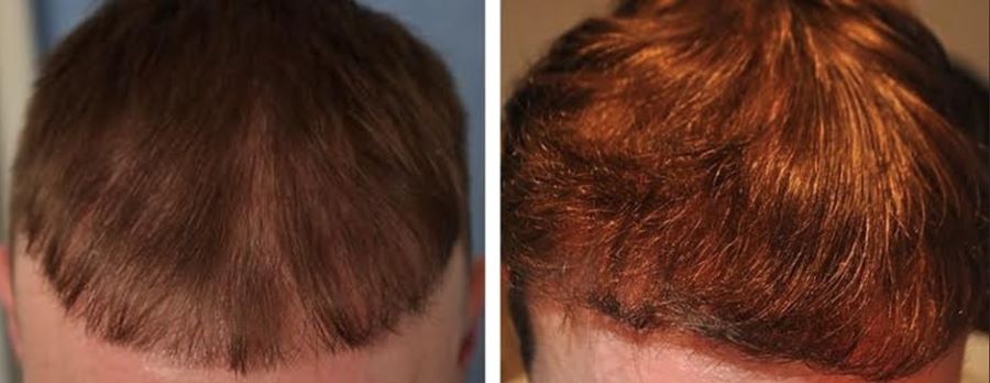FUE hair transplant before and after