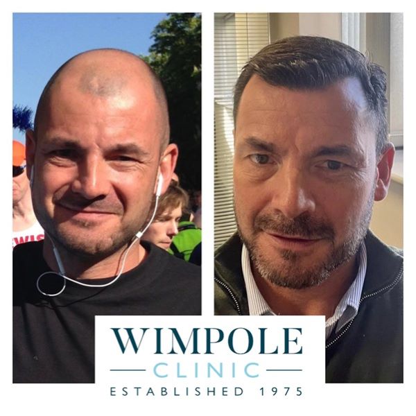 Man before and after Wimpole Clinic hair transplant
