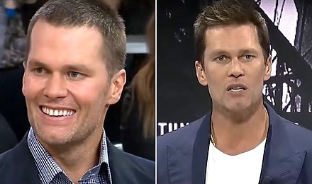 Tom Brady’s Hair Transplant: Did It Really Happen?