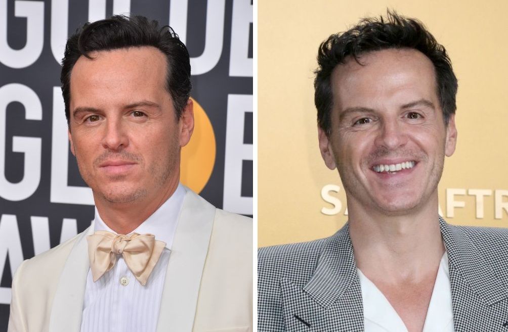 Andrew Scott hair transplant