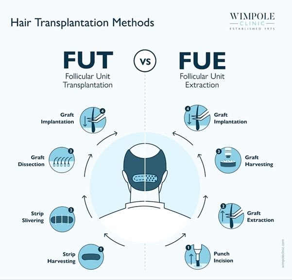 FUT vs FUE beard transplant