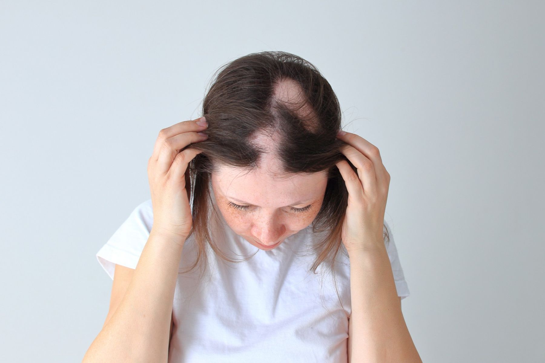 alopecia areata