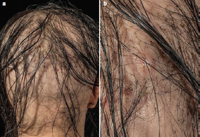 post bio fibre transplant infection