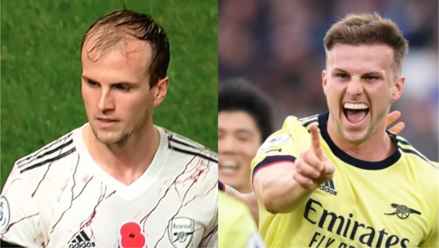 Footballer hair transplant