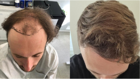 male hair transplant results