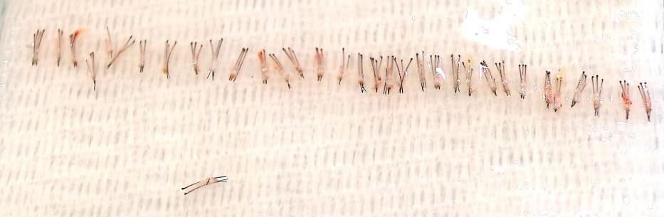 Extracted grafts