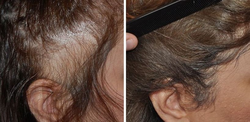 Female patient before and 18 months after her 1500-graft FUT hair transplant