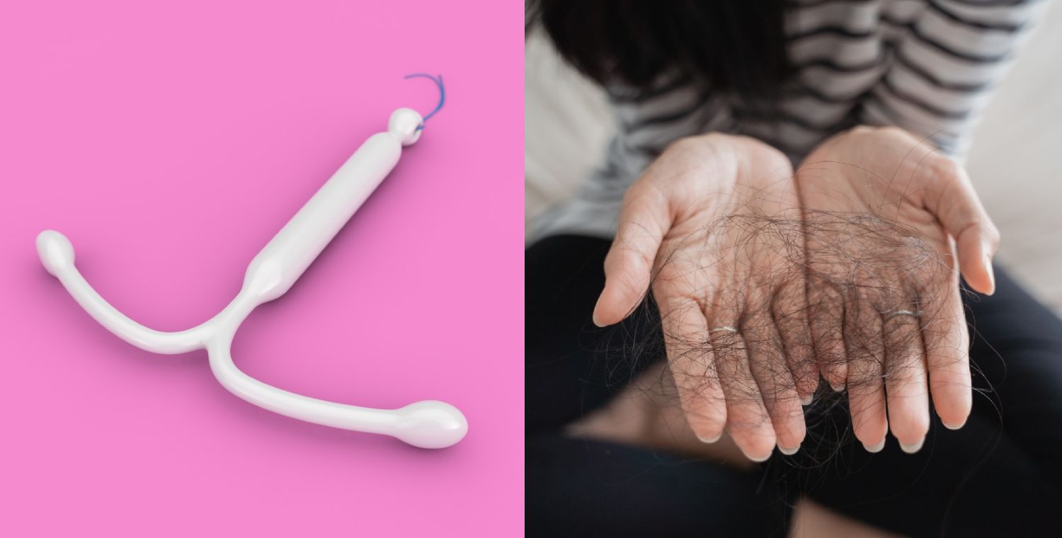 Mirena IUD Hair Loss Causes, Symptoms and Solutions