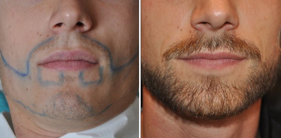 Before and 11 months after beard and moustache transplant