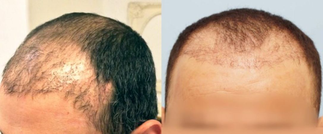Patient with poor transplanted hair growth or graft failure from a botched hair transplant