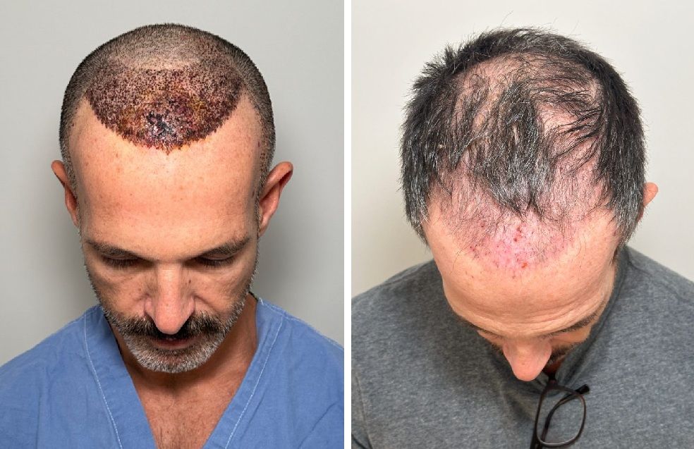 Results from a black market hair transplant done in Turkey