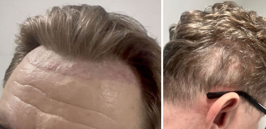 Results of a botched hair transplant