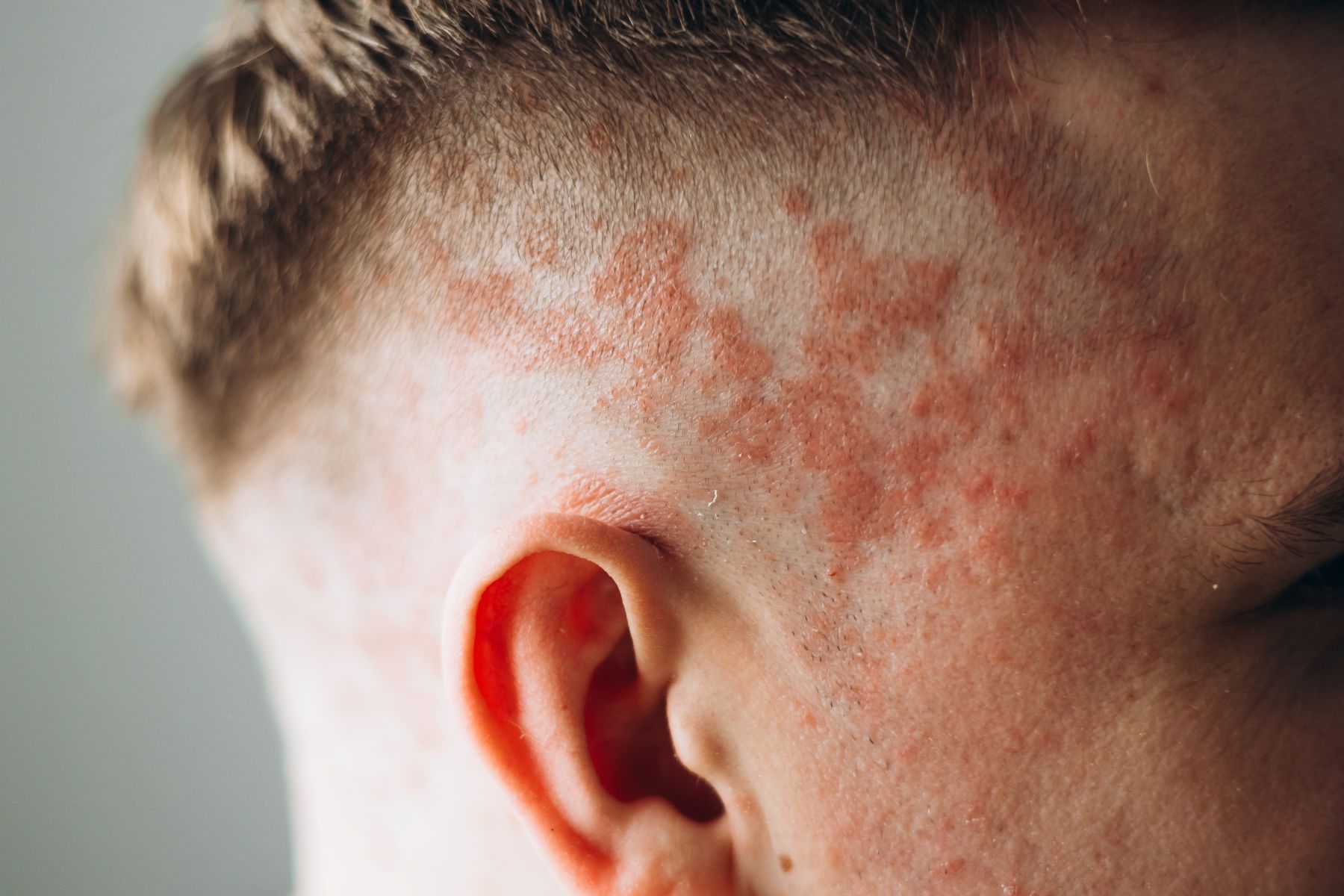 Scalp psoriasis