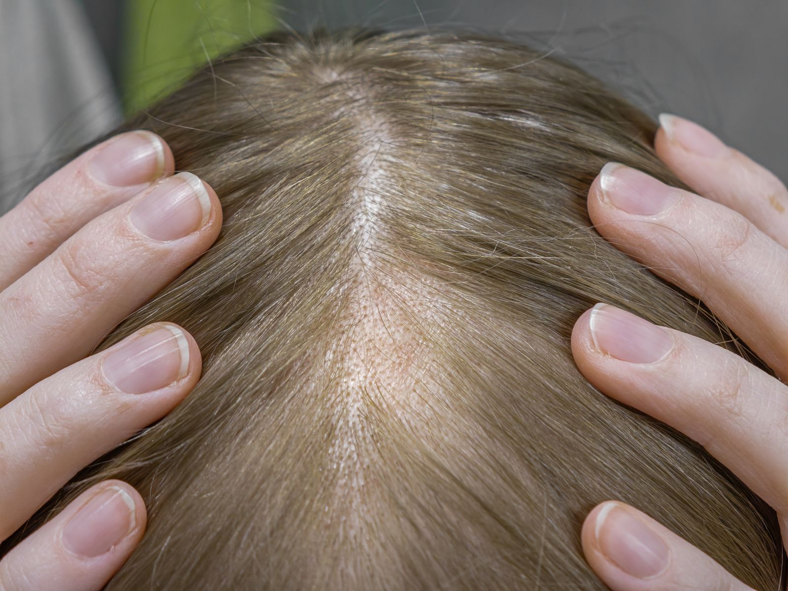 telogen effluvium