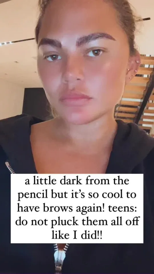 Chrissy Teigen’s Eyebrow Transplant: Overplucked Brow Transformation, Wimpole Clinic