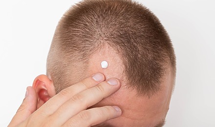 Clascoterone Hair Loss