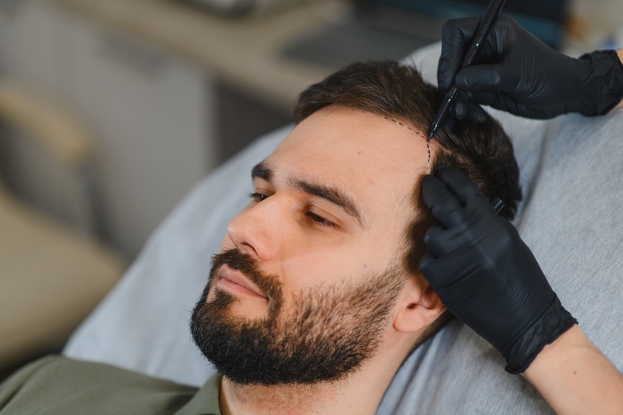 Hair Transplant Guarantee Featured Image