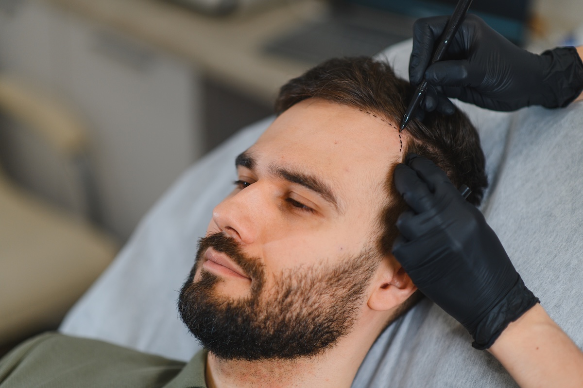 hair transplant guarantee featured image