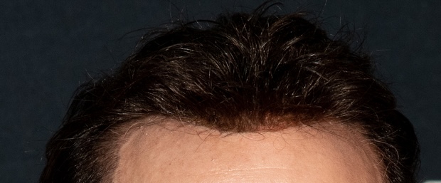 Close up of Nicolas Cage’s hairline (2022)