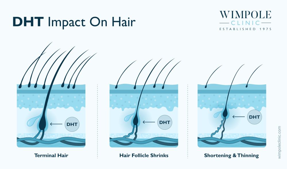 DHT impact on hair